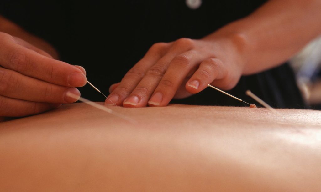 L'acupuncture, un soin alternatif
